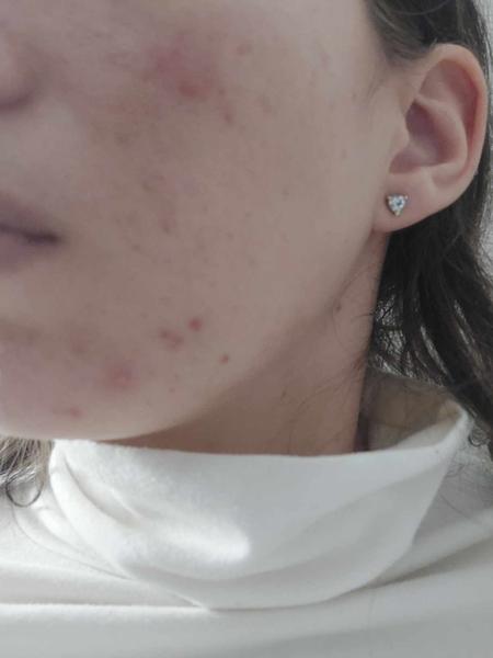 Je silné akné dôsledkom intolerancie na potraviny?