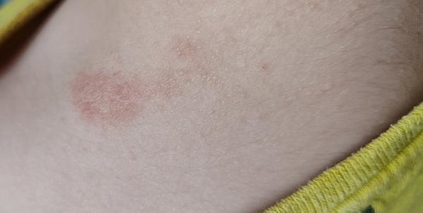 Čo je to za vyrážku?