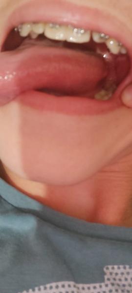 Môže ma bolieť jazyk kvôli hrbolčekom?