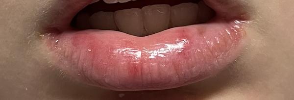 Čo spôsobuje biele pľuzgieriky na perách?