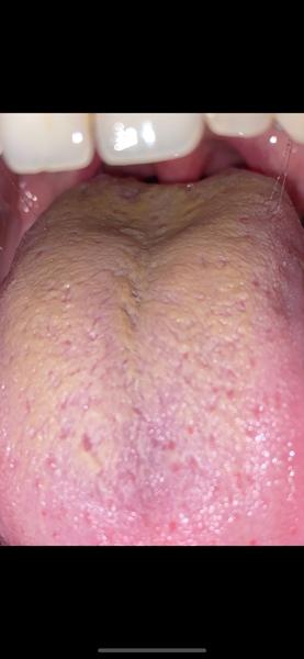 Môže byť povlak na jazyku plesňou alebo nejakým vírusovým ochorením?