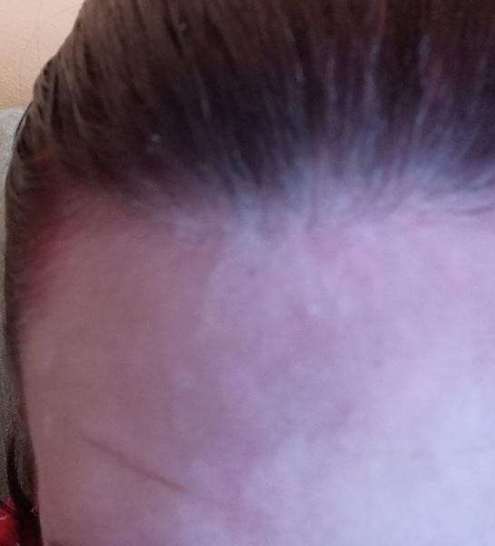 Prečo sa mi tvoria biele fliačiky na čele?