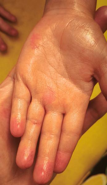 Fľaky a zosupaná koža na detských rukách