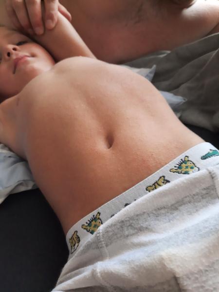 Má syn vyrážky na tele z prachu a aviváže?