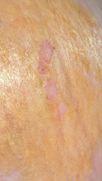 Poranenie kože na prsníku