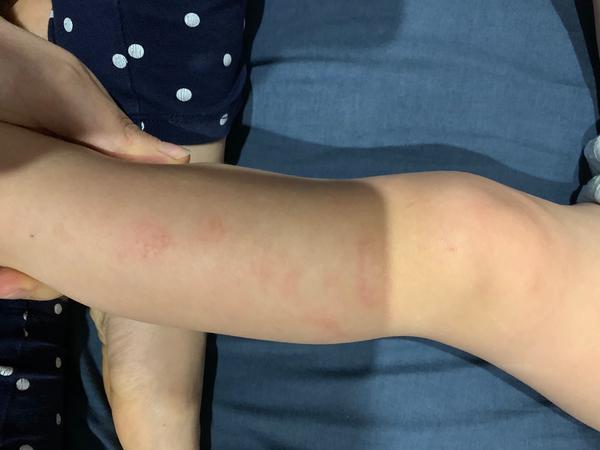 Aké suché miesta na nožičkách má moja dcérka?