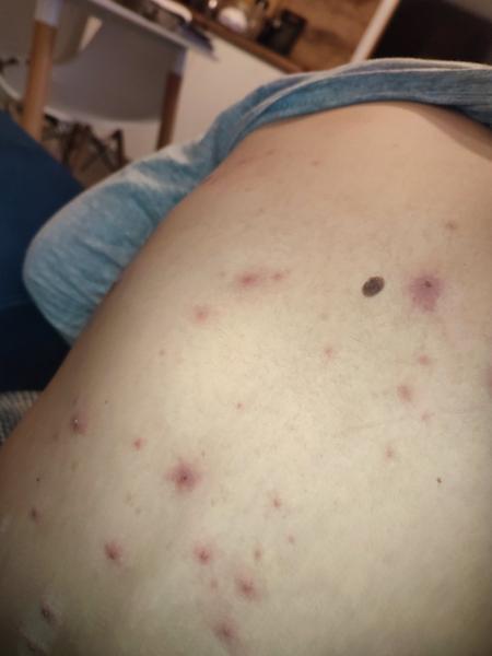 Ovčie kiahne - červené okolie vyrážky