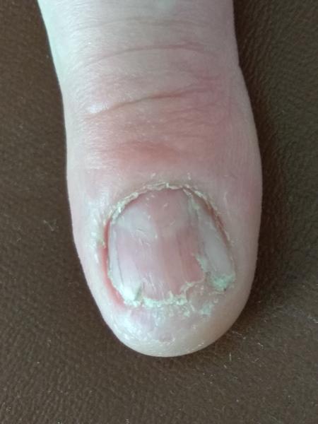 Poškodený necht