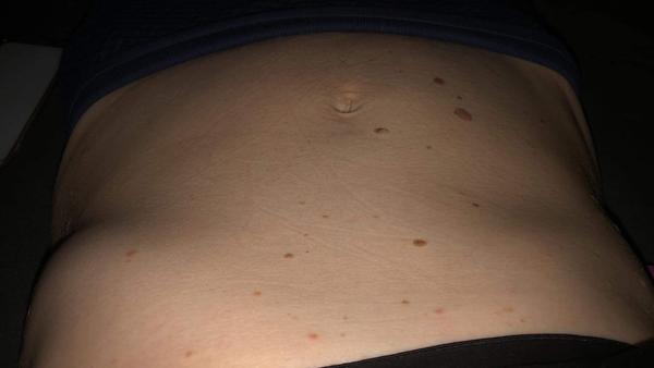 Prečo mám ľavú stranu rebier viac vypuklú?