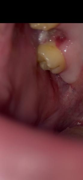 Extrakcia hornej 6ky