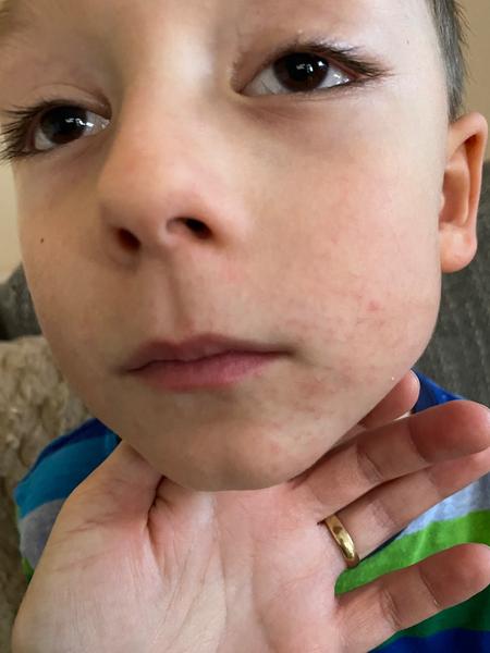 Kožná reakcia u päťročného syna po sladkostiach