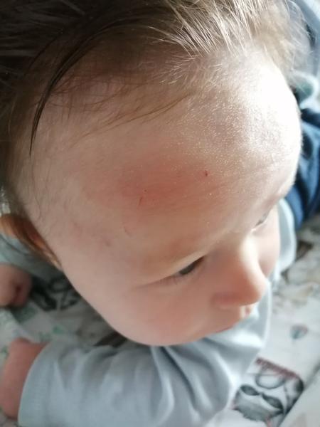 Je začervenianie pokožky u štvormesačného bábätka spôsobené pracím práškom?