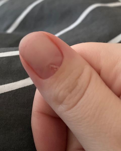 Čo znamenajú prasknuté nechty pri ich odrastaní?