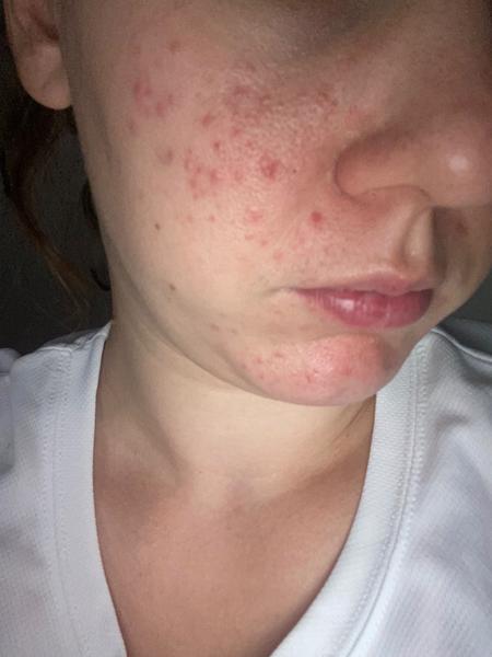 Ako riešiť vyrážky na tvári?