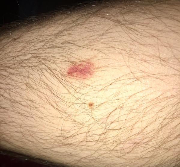 Je táto vyrážka po uštipnutí normálna?