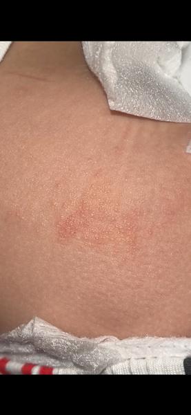 Ako riešiť vyrážky u dieťaťa na panve?