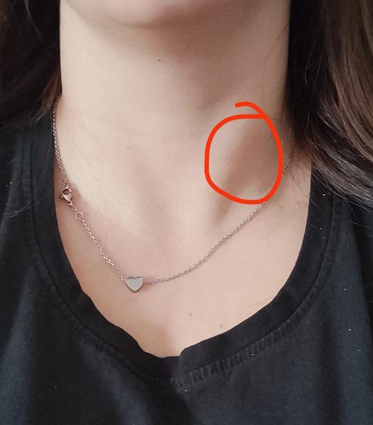 Čo spôsobuje bolesť pri otáčaní krku?