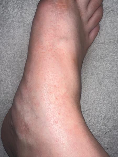 Sú svrbivé vyrážky na chodidlách nebezpečné počas tehotenstva?