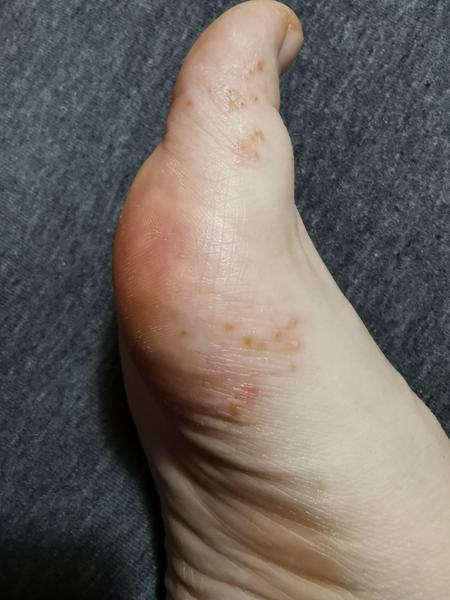 Ako liečiť zvláštny ekzém na chodidlách?