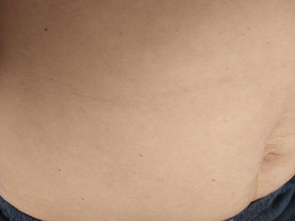 Zo dňa na deň sa mi urobilo plné brucho angiómov. Mám rakovinu?