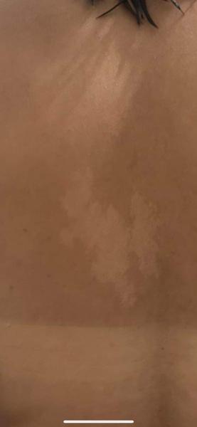 Je to začínajúce vitiligo?