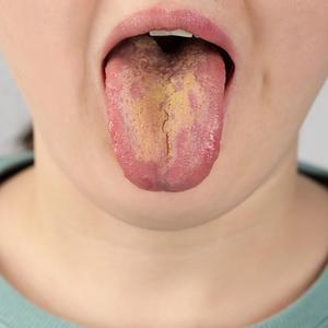 Čo je múčnivka a prečo vzniká?