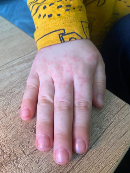 Alergická žihľavka u detí: Skúsenosti a rady?