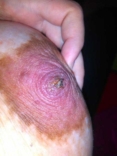 Chrasty na prsníkoch v 36. týždni