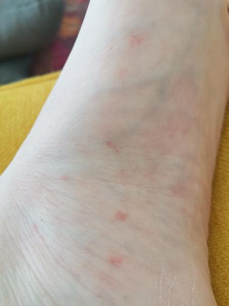 Čo spôsobuje červené fľaky na chodidlách?