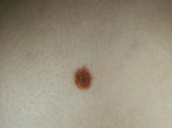 Môže byť moje znamienko nebezpečné?