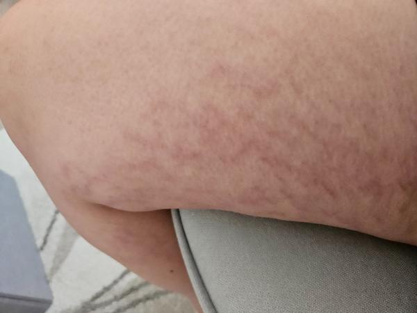 Ako efektívne riešiť strie počas tehotenstva?