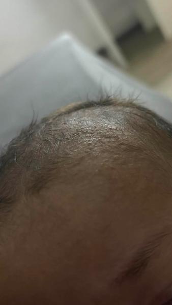 Ako rozoznať detské akné od ekzému?