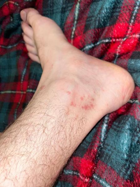 Čo spôsobuje svrbiace vyrážky po celom tele?