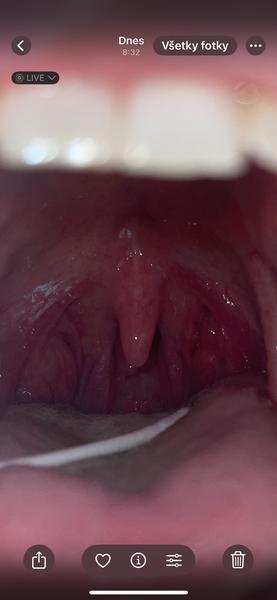 Chronický zápal a nepríjemný zápach krčných mandlí