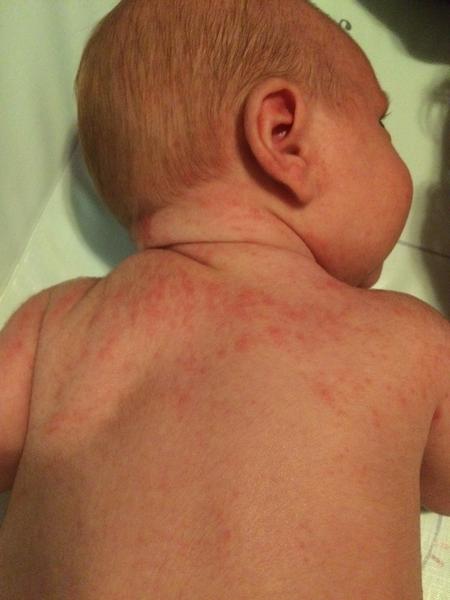 Aký výsyp má môj 7 týždňový synček na telíčku?