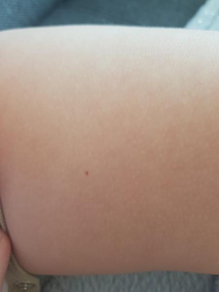 Od akého veku sa deťom tvoria znamienka?