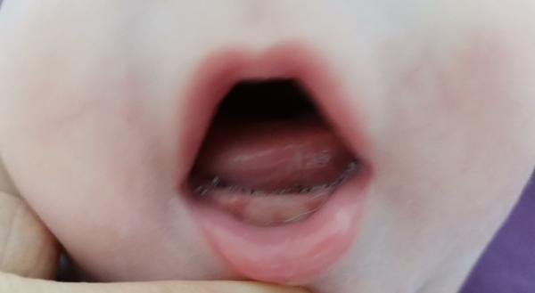 Teplota u bábätka - zuby