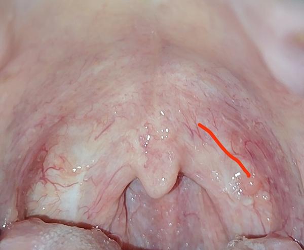 Výrastok po operácii krčných mandlí