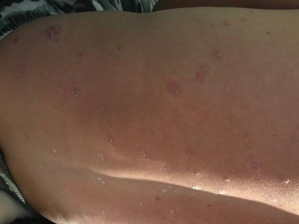 Aký kožný problém ma trápi už dva mesiace?