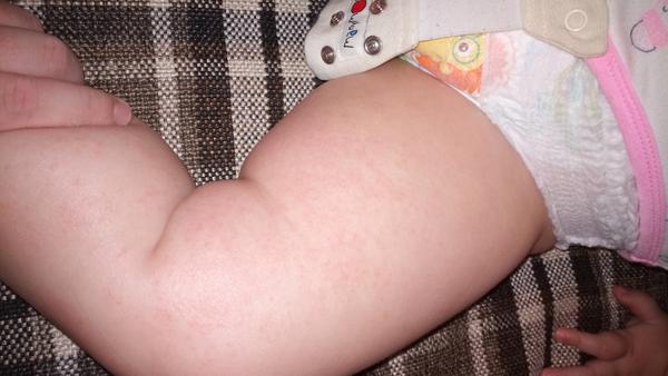 Má moja dvojročná dcérka ekzém, alebo reakciu na perkarbonát sodný?