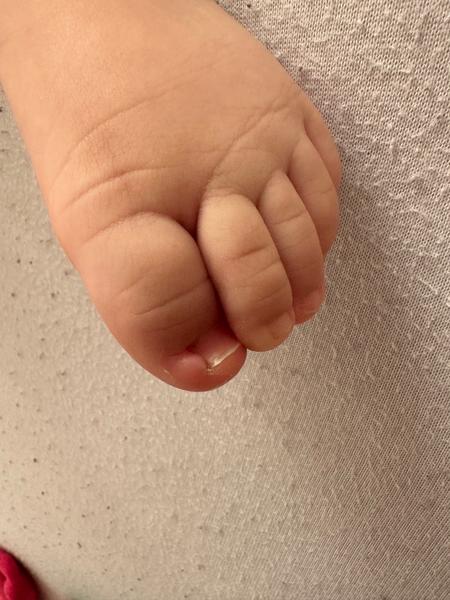 Opuch na prste u ročného dieťaťa