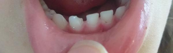 Je potrebné riešiť, keď má dieťa zlomený zub?