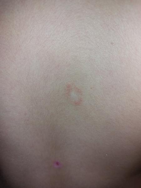 Poradíte, či ísť s kožným problémom k lekárovi?