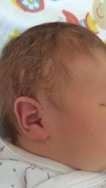 Dierka nad uškom novorodenca