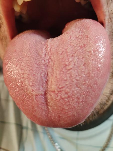 Štípanie a pálenie jazyka bez zjavnej príčiny