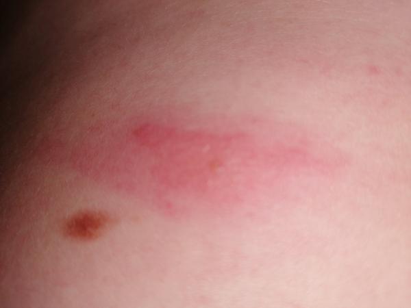 Je nevoľnosť reakciou na uštipnutie?