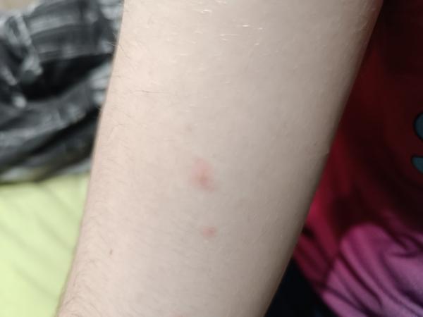 Ako rozpoznať, či sú to kiahne?