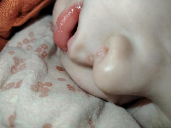 Je to impetigo alebo herpes?