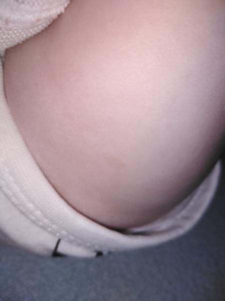 Svetlohnedé fľaky na tele trojmesačného bábätka