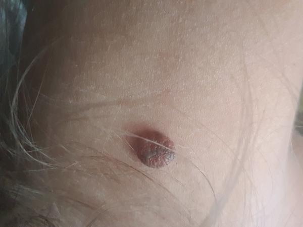 Na aké vyšetrenie mám ísť, keď ma ťahá znamienko a som tehotná?